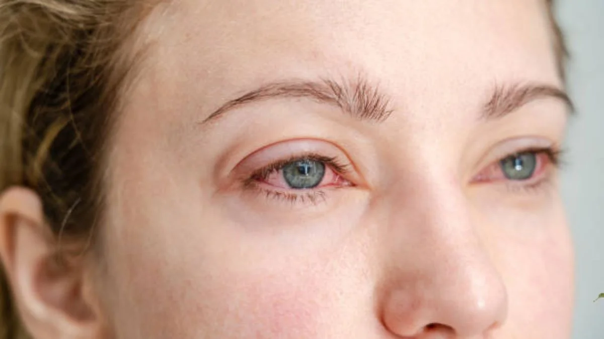 Eye Redness Cause